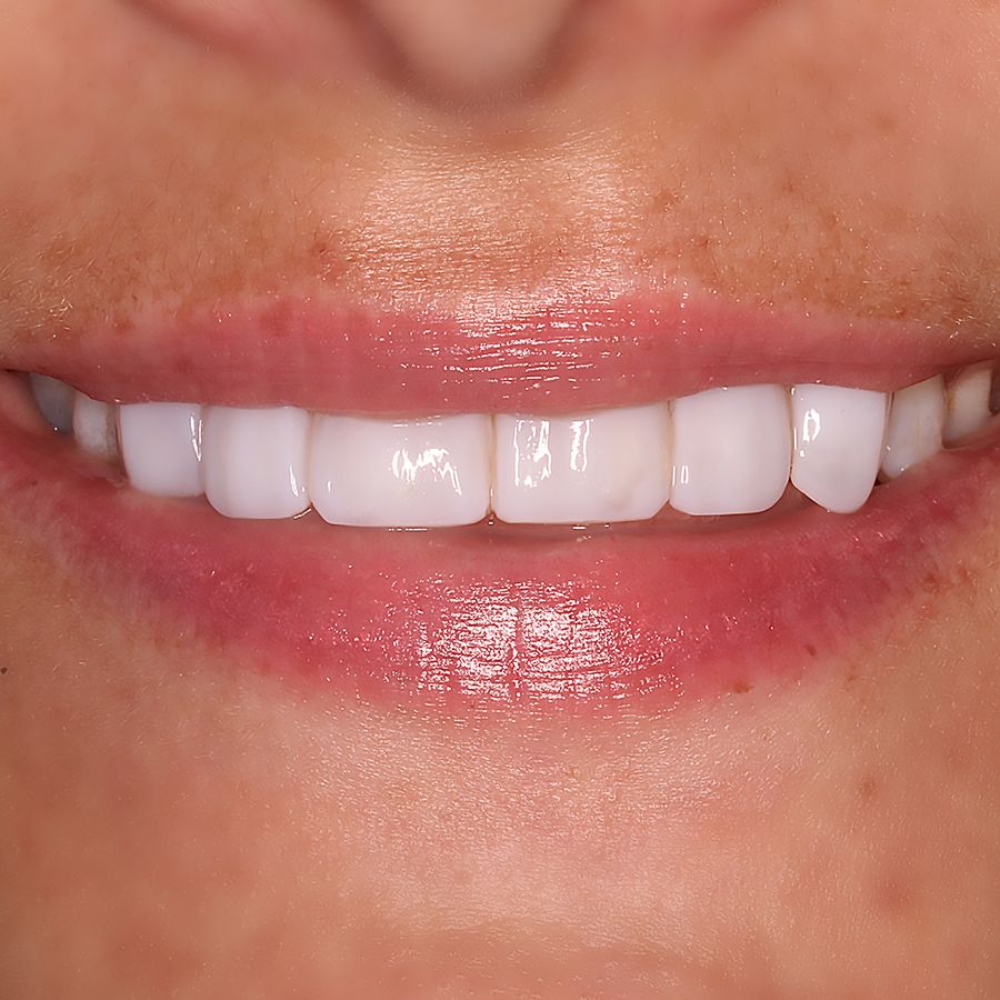Composite veneers - after - 3Dental - Dublin & Limerick